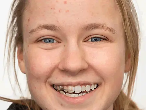 Skin retouching